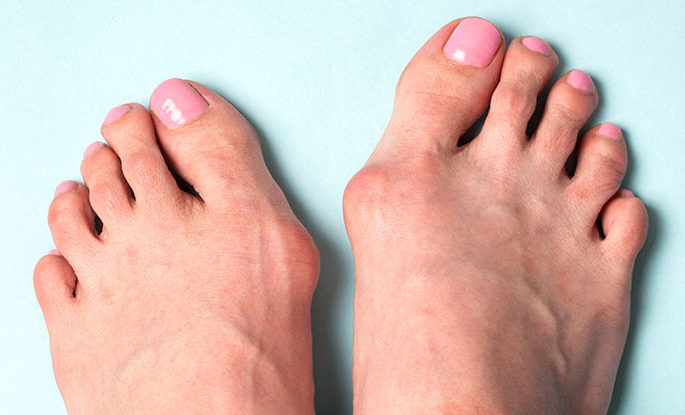 Valgus deformity