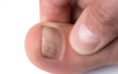 What Kills Toenail Fungus Instantly?