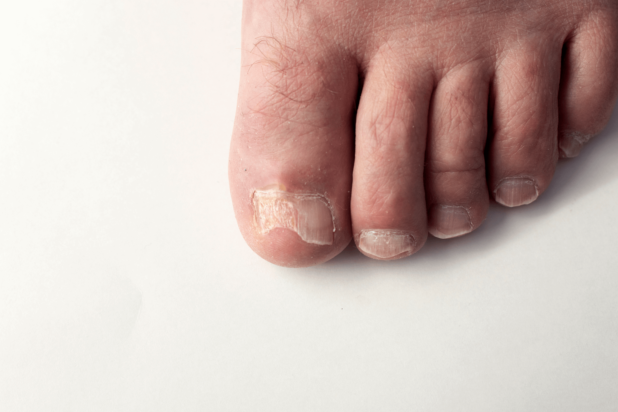 Toenail fungus on foot of a person. Damaged toenail