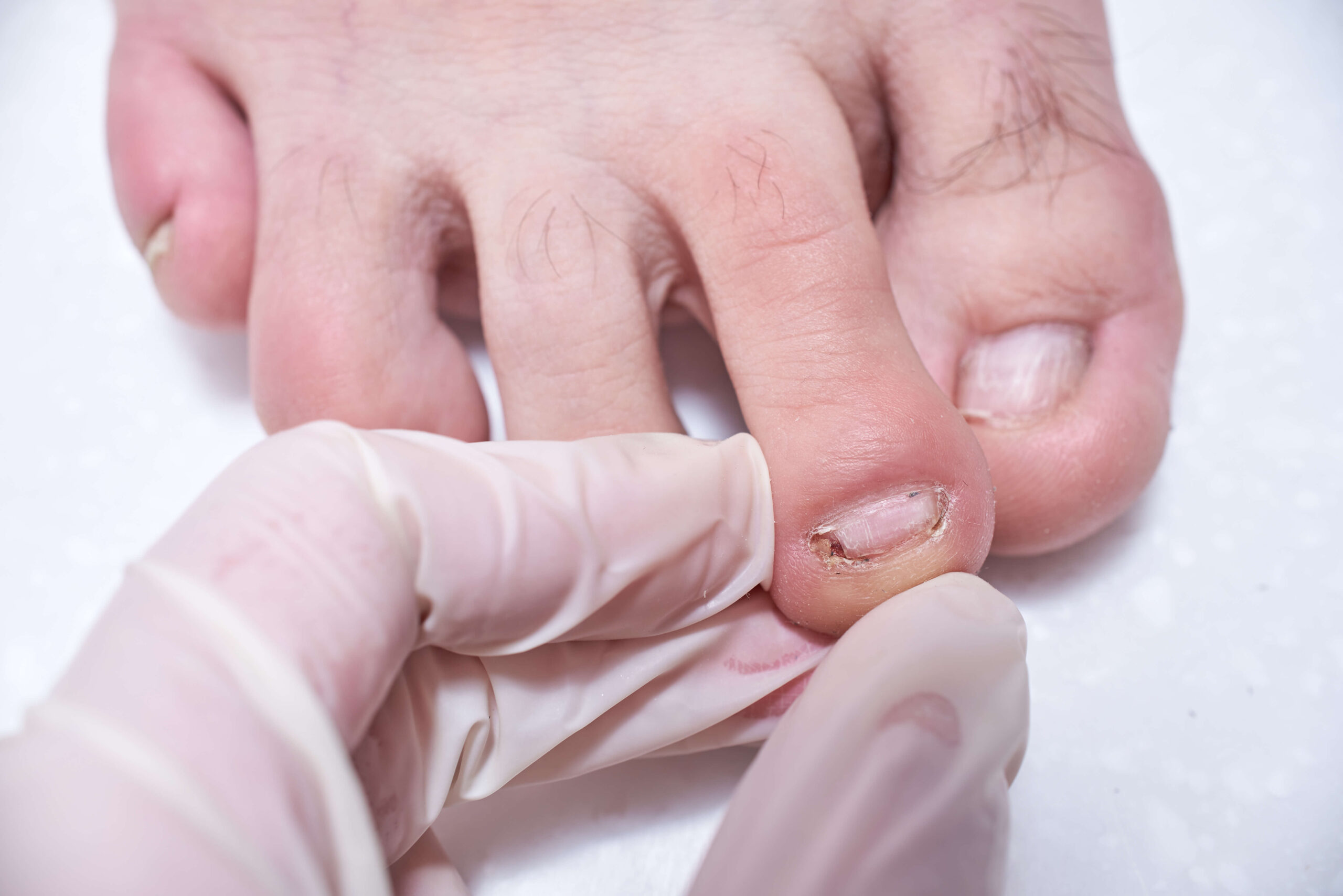 The doctor-podiatrist does an examination of the patient's foot in the clinic. Podiatrist treating toenail fungus. Podology treatment.