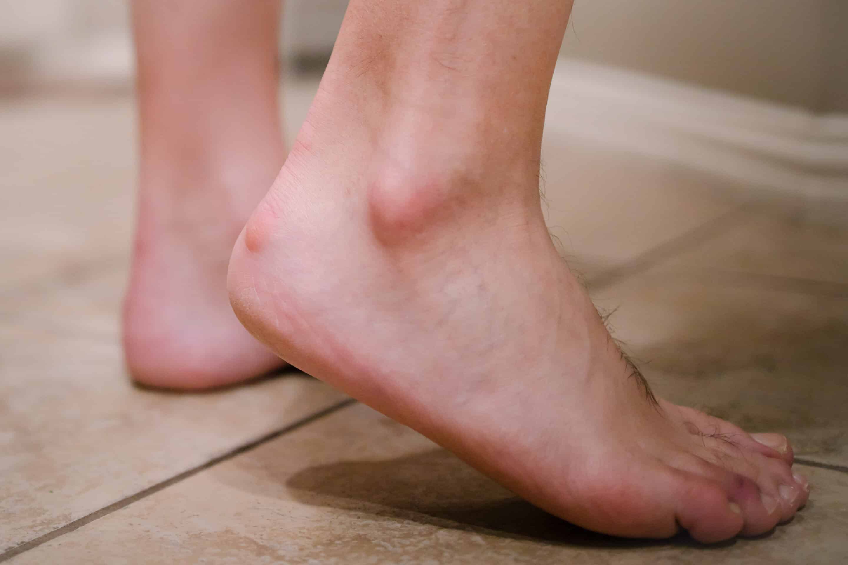 Close up view of an Adult male foot with a bony protrusion called Haglund's deformity on his heel