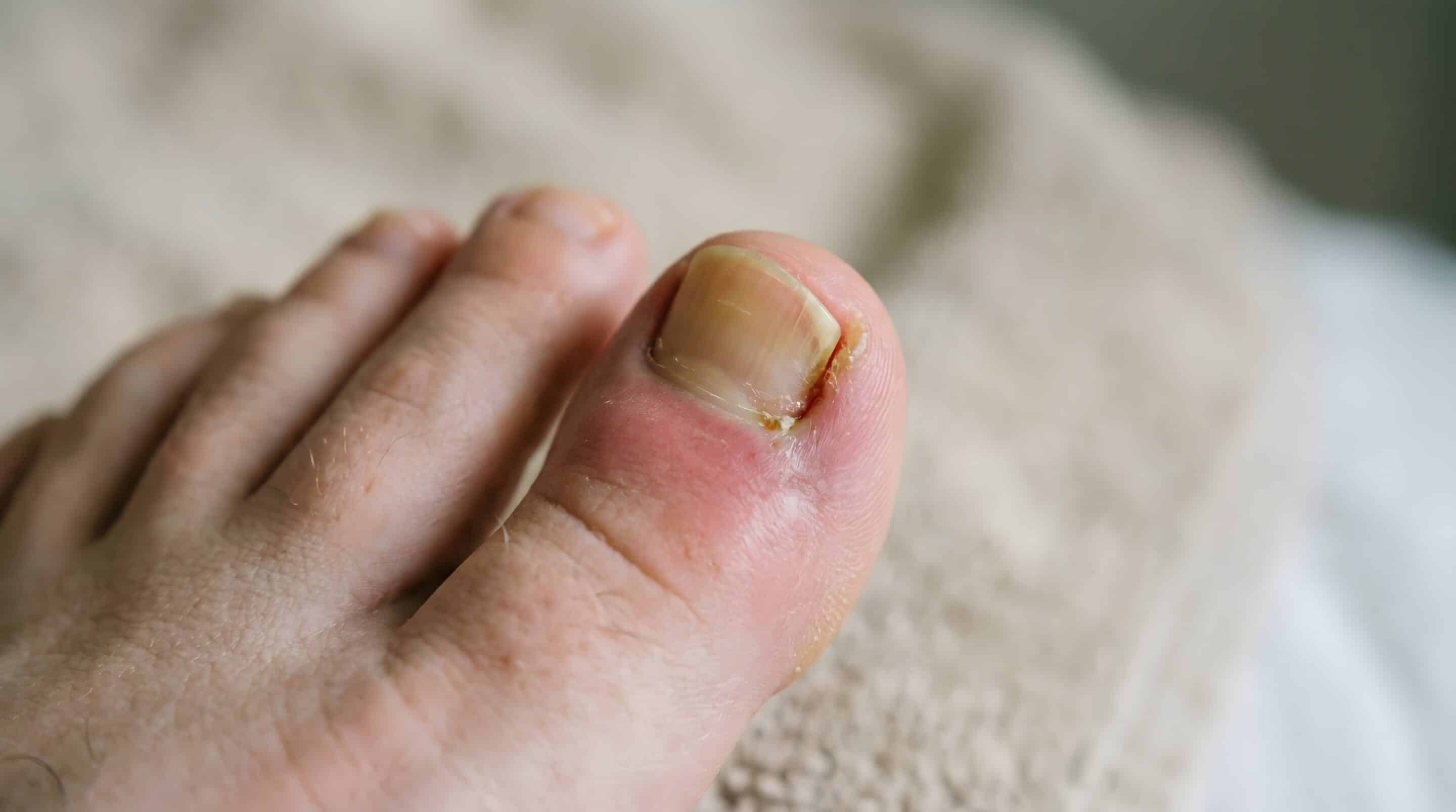 Macro photo of painful inflamed ingrown toenail on human big toe Macro photo of painful inflamed ingrown toenail on human big toe