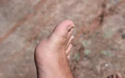 How to Treat an Ingrown Toenail