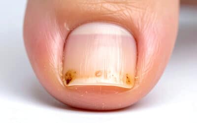 What Causes Toenail Fungus?