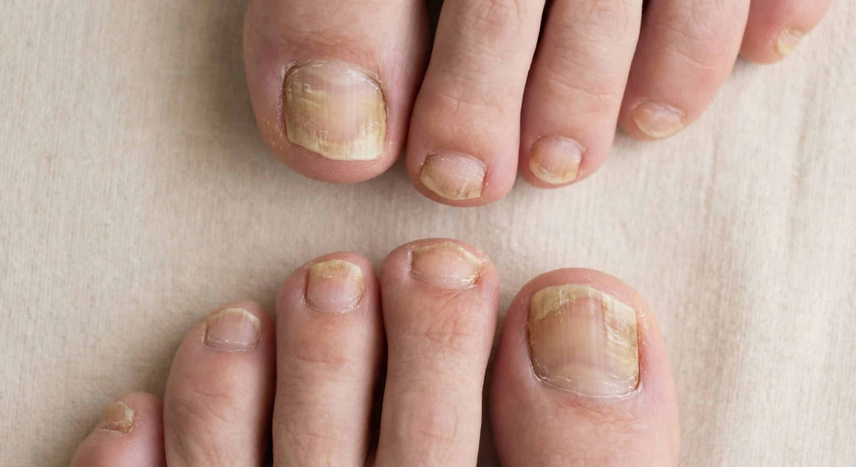 Fungal toenail infection onychomycosis macro view